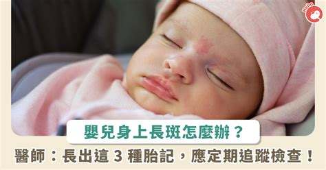 蒙古胎记|胎記？蒙古斑？如何觀察與判斷診治｜Mombaby 媽媽 